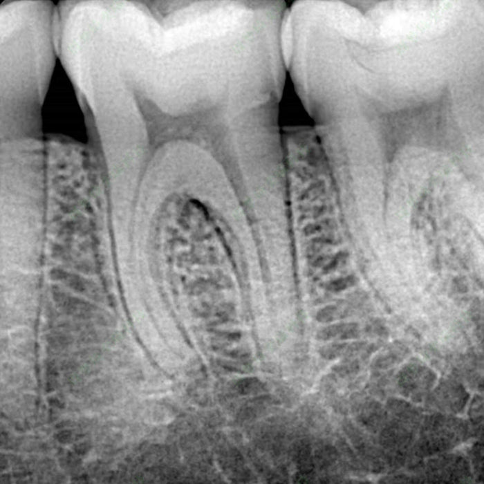 iRay Digital Intra-oral X Ray Sensors Black - JMU DENTAL INC
