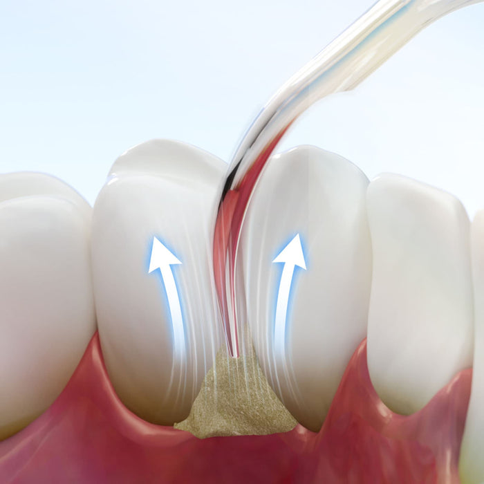 Woodpecker UDS-T LED Ultrasonic Scaler for scaling periodontal endodontic and implant procedures - JMU Denta