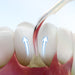Woodpecker UDS-T LED Ultrasonic Scaler for scaling periodontal endodontic and implant procedures - JMU Denta